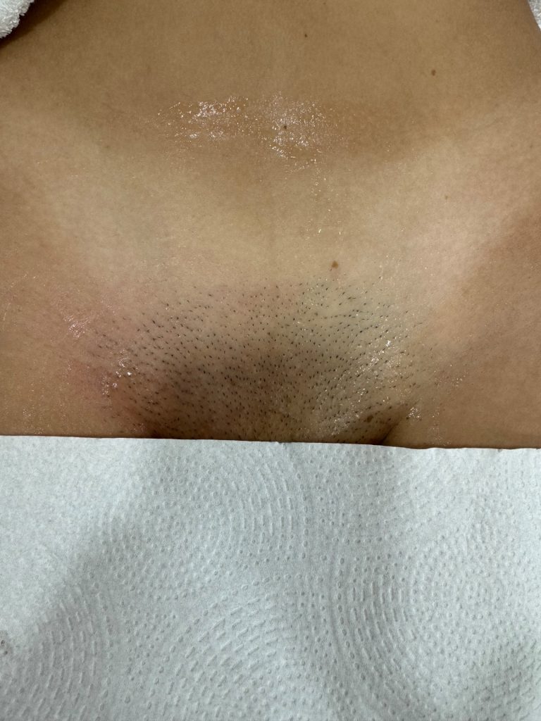 Antes — Virilha completa